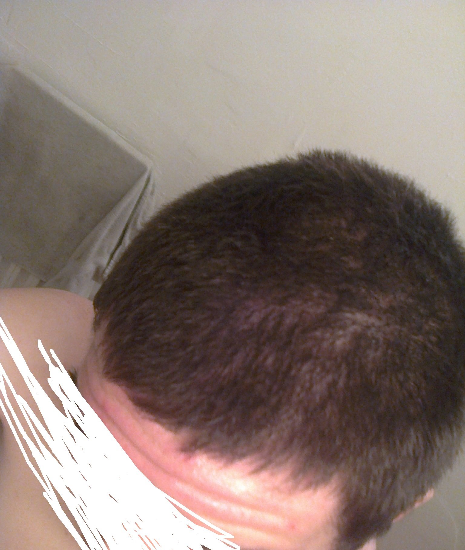Impression de troue dans les cheveux... Calvitie et perte de cheveux FORUM Santé Doctissimo