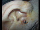La fin du tragus (grosse infection ?) - Forum Tatouage et Piercing 