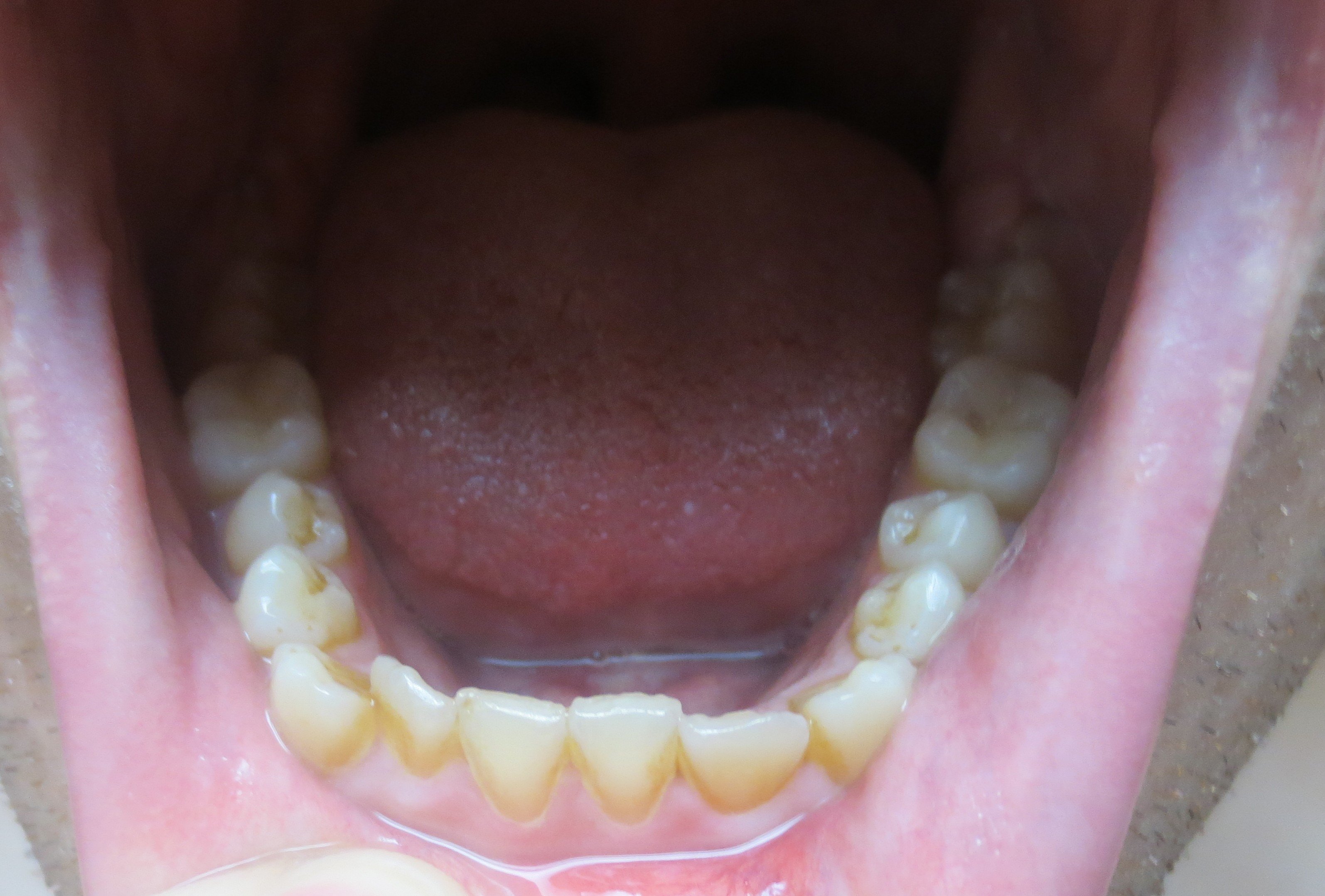 Parodontites or gingivites ? [Photos] - Problèmes dentaires - FORUM