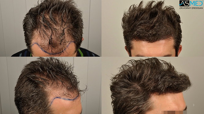 matt pokora greffe cheveux