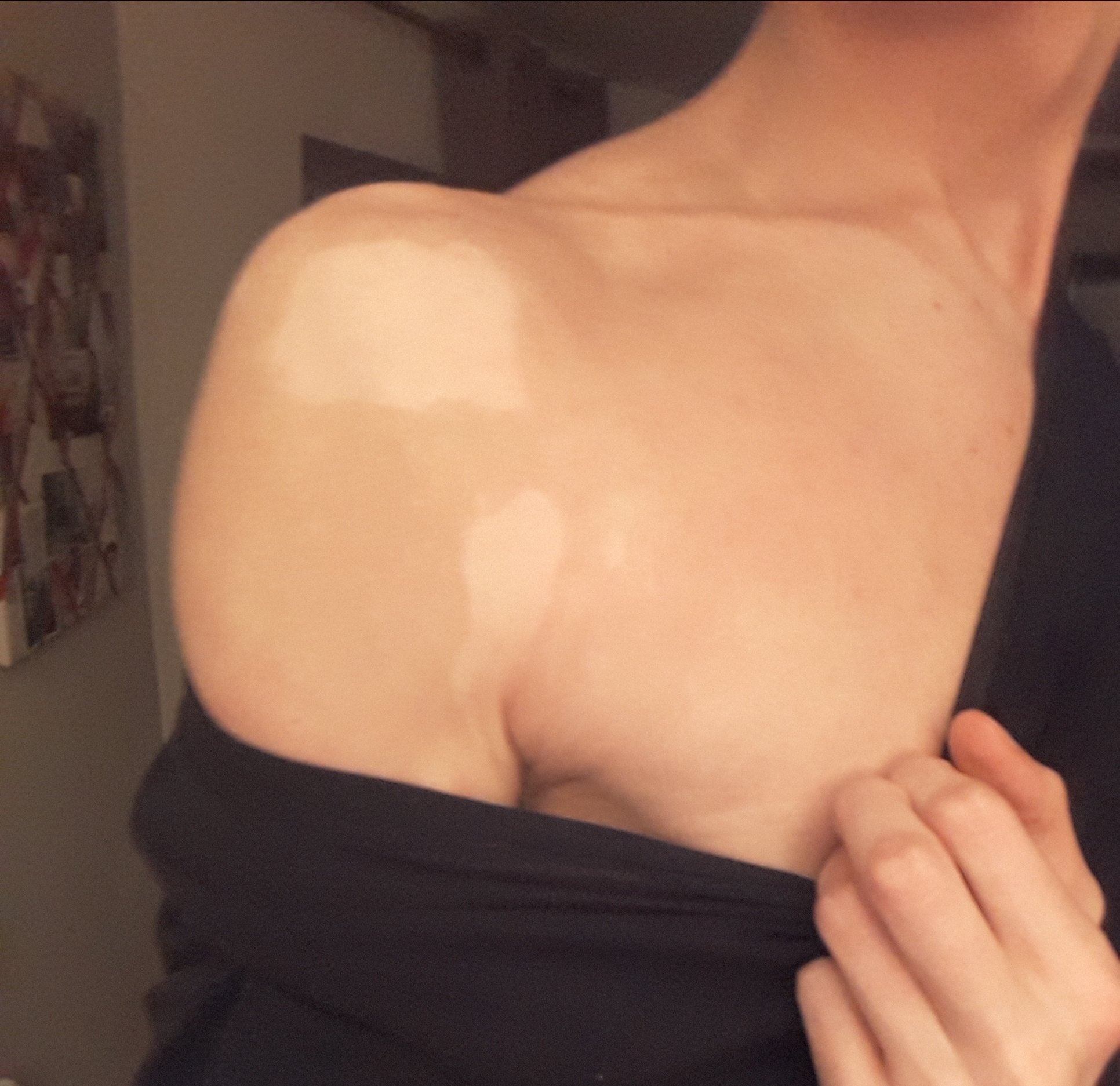 HELP les khey médecins: c'est un vitiligo? sur le forum Blabla 18 ...