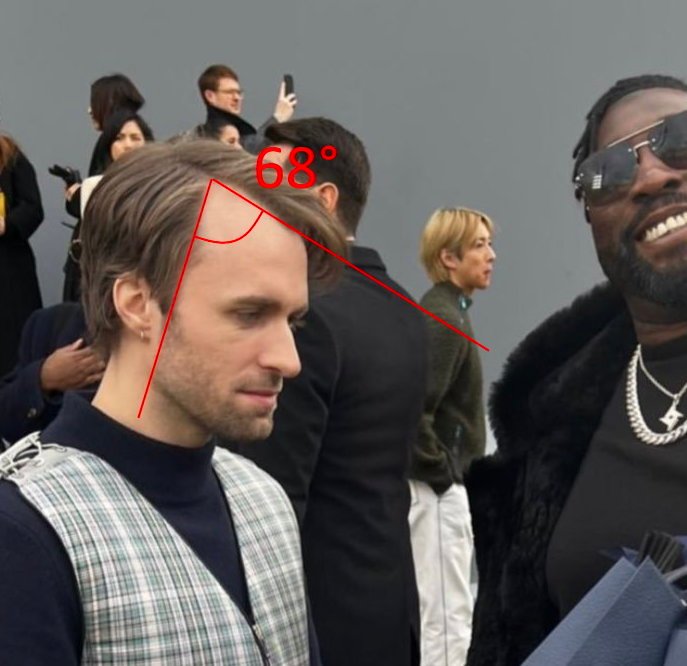 [Photo] La greffe capilaire de Squeezie réussie ou pas ? sur le forum Blabla 1825 ans 1009
