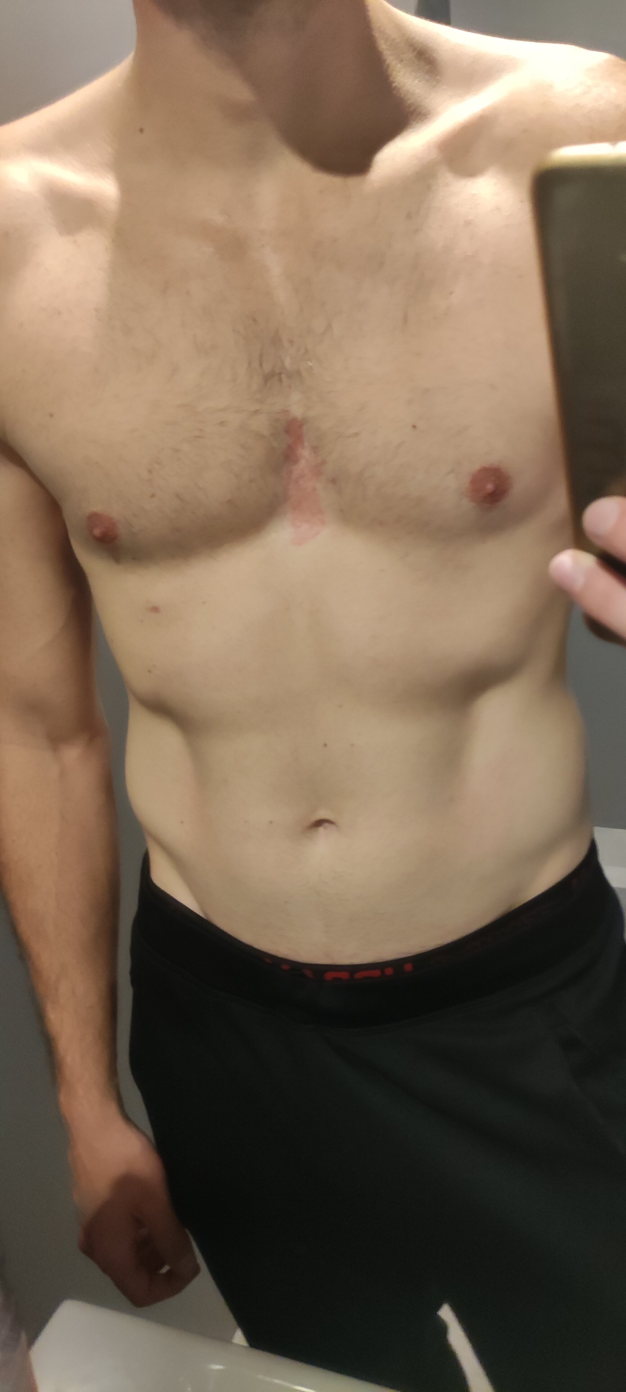 [PHOTO] Je possède de splaques rougeâtres sur le torse sur le forum ...