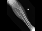 https://image.noelshack.com/fichiers/2012/40/1349559591-fracture.jpg