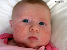 https://image.noelshack.com/fichiers/2012/44/1351896893-valuable-tips-for-baby-acne-treatment-2397.jpg
