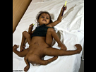 https://image.noelshack.com/fichiers/2014/01/1388773589-9-baby-with-multiple-limbs.jpg