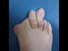 https://image.noelshack.com/fichiers/2014/23/1401747876-hallux-valgus-pre-post-thumb.jpg