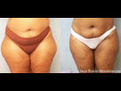 https://image.noelshack.com/fichiers/2015/18/1430261648-liposuccion-culotte-de-cheval-sur-peau-distendue.jpg