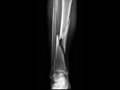 https://image.noelshack.com/fichiers/2016/07/1456008302-3fracture-istock16395088-mda.jpg
