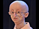 https://image.noelshack.com/fichiers/2017/45/6/1510417156-progeria-syndrome.jpg