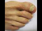 https://image.noelshack.com/minis/2017/51/2/1513692349-mycose-ongle.png