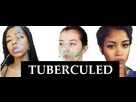 https://image.noelshack.com/minis/2018/02/6/1515883833-tuberculed2.png