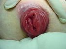 https://image.noelshack.com/minis/2018/03/1/1515988905-prolapsus-rectal.png