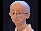 https://image.noelshack.com/fichiers/2018/12/1/1521476687-1510417156-progeria-syndrome.png