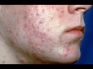 https://image.noelshack.com/fichiers/2018/27/2/1530574020-acne-severe.jpg