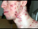 https://image.noelshack.com/fichiers/2018/33/7/1534675315-severe-acne-pictures-1.jpg