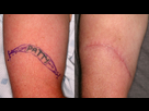 https://www.noelshack.com/2019-14-3-1554243669-tattoo-removal-surgical-excision-visakhapatnam.jpg