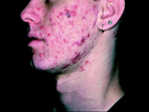 https://image.noelshack.com/fichiers/2019/26/5/1561729914-severe-acne-2.jpg