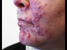 https://image.noelshack.com/fichiers/2019/29/3/1563351500-acne-cyst-1.jpg