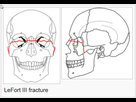 https://image.noelshack.com/fichiers/2020/06/6/1581180697-le-20fort-20fracture-20of-20skull-20-20wikipedia-20the-20free-20encyclopedia-2014-07-22-16-57-19.png