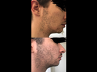 https://image.noelshack.com/fichiers/2020/30/5/1595601715-minoxidil-evolution-2-mois.jpg