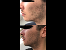 https://image.noelshack.com/fichiers/2020/30/5/1595601728-minoxidil-evolution-2-mois-1.jpg