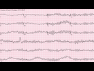 https://image.noelshack.com/fichiers/2021/14/1/1617639188-ventricular-fibrillation.png