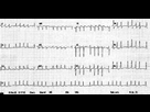 https://image.noelshack.com/fichiers/2021/18/1/1620005190-ecg-interessant-3.png