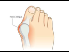 https://image.noelshack.com/fichiers/2021/25/4/1624528415-hallux-valgus.jpg