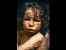 https://image.noelshack.com/fichiers/2021/28/5/1626447471-child-with-smallpox-bangladesh.jpg