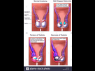 https://image.noelshack.com/fichiers/2021/31/1/1627856522-torsion-testiculaire-avec-myocarde-ulterieurs-adtrh2.jpg