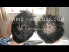 https://image.noelshack.com/fichiers/2021/31/2/1628023325-twins-hair-loss-comparison-photo-12.jpg