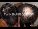 https://image.noelshack.com/fichiers/2021/31/2/1628023333-twins-hair-loss-comparison.jpg