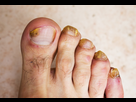 https://image.noelshack.com/fichiers/2021/36/1/1630955892-fungus-infection-on-nails.jpg