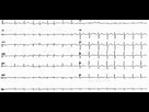 https://image.noelshack.com/fichiers/2021/40/6/1633787140-petit-ecg.png