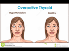 https://image.noelshack.com/fichiers/2022/03/5/1642730516-face-adult-female-exhibiting-symptoms-hyperthyroidi-hyperthyroidism-109451172.jpg