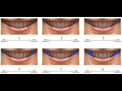 https://image.noelshack.com/fichiers/2022/07/6/1645278319-series-reference-images-illustrating-the-range-of-buccal-corridors-blue-area.png