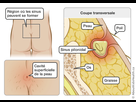 https://image.noelshack.com/fichiers/2022/11/2/1647329742-imd-pilonidal-sinus-fr.jpg