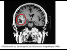 https://image.noelshack.com/fichiers/2022/23/5/1654843489-diagnostic-irm-tumeur-crbrale.png