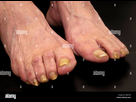 https://image.noelshack.com/fichiers/2022/26/2/1656430846-pieds-d-une-femme-avec-les-champignons-des-ongles-jgryhr.jpg