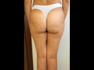 https://image.noelshack.com/fichiers/2022/26/3/1656532969-cellulite-1.jpg