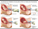 https://image.noelshack.com/fichiers/2022/26/3/1656537273-de-abortion-645-469-55.jpg