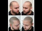 https://image.noelshack.com/fichiers/2022/41/5/1665757810-what-is-scalp-micropigmentation-1.jpg