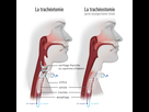 https://image.noelshack.com/fichiers/2022/42/3/1666198324-la-tracheotomie-et-la-tracheostomie.png