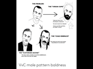 https://image.noelshack.com/fichiers/2022/42/4/1666291555-vvc-male-pattern-baldness-68270441.png