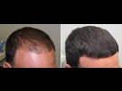 https://image.noelshack.com/fichiers/2023/03/5/1674203841-finasteride-before-and-after-6-months.jpeg