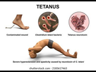 https://image.noelshack.com/fichiers/2023/07/3/1676484632-mechanism-tetanus-disease-3d-illustration-260nw-2183617463.jpg