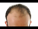 https://image.noelshack.com/fichiers/2023/22/2/1685409416-alopecia-difusa.jpg