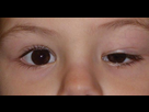 https://image.noelshack.com/fichiers/2023/33/4/1692284437-le-ptosis-12955-3-600.jpg
