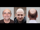 https://image.noelshack.com/fichiers/2024/10/3/1709728012-round-skull-shape-hair-loss-link.jpg